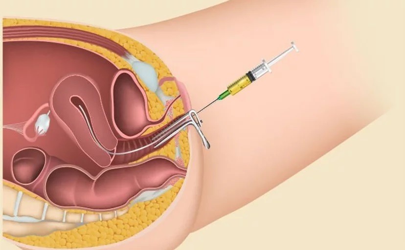 Hysteroscopic Tubal Cannulation